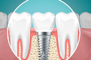 Image of single dental implant