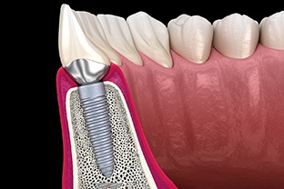 an example of how dental implants work in Peabody