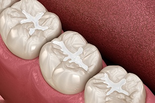 an illustration of tooth-colored cosmetic fillings