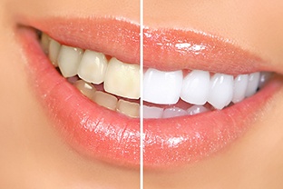 a before-and-after shot of the teeth whitening process