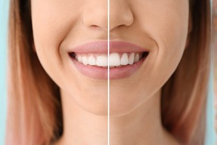 a person smiling after undergoing gum contouring
