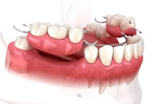 a digital illustration of partial dentures in Peabody