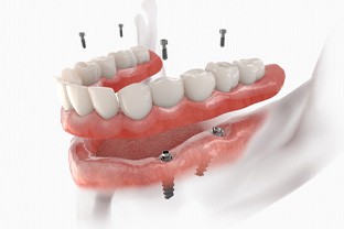 a digital example of implant dentures in Peabody