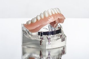 Model of an implant-supported lower denture