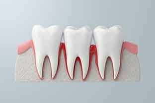 Gum disease is a bacterial infection of the gums