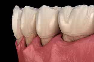 receding gums is one of the symptoms of gum disease