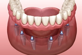 an illustration of implant dentures in Peabody