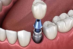 single dental implant with a crown