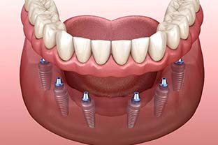 six dental implants supporting a full denture