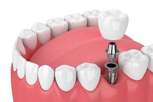 dental implant supporting a single dental crown