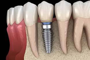 dental implant fused to the jawbone