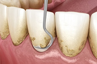 a 3D illustration of scaling and root planing