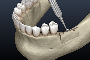 a digital illustration of ridge augmentation