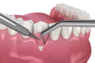 an illustration of soft tissue grafting in Peabody