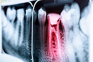 an X-ray of a root canal in Peabody