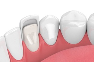 Illustration of veneer being placed on bottom, front tooth