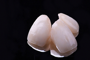 Image of porcelain veneers in Peabody.