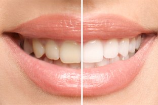 Before and after teeth whitening photos
