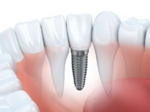 Image of a dental implant in the jaw