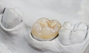 A dental crown sitting in a fabricated jaw.