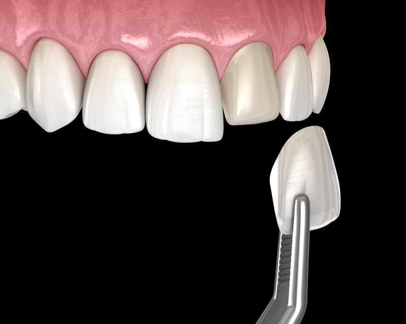 illustration of veneer being applied