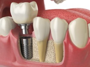 illustration of dental implants 