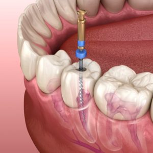 root canal 3D illustration 