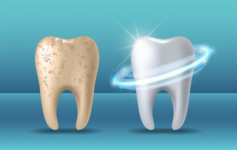 Illustration of teeth whitening.