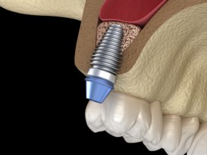 Digital model of dental implant in jawbone