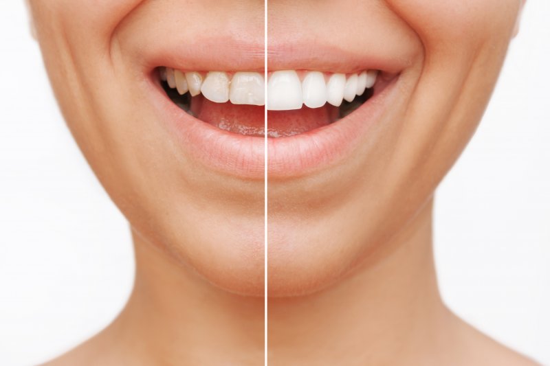 Woman smiling with top teeth showing side-by-side comparison of without and with veneers