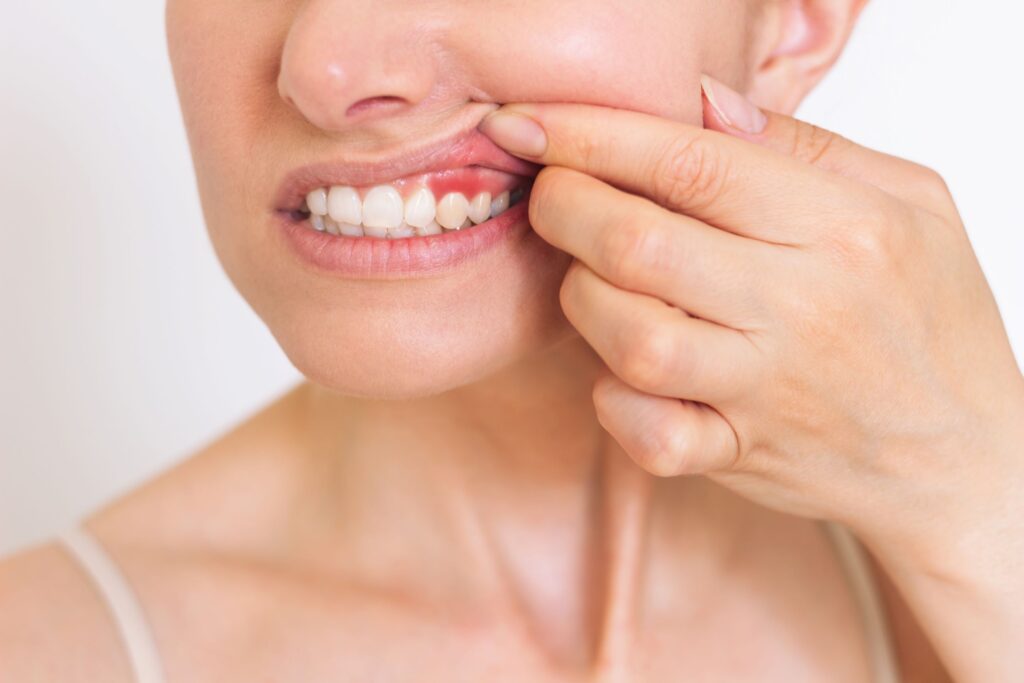 Nose-to-shoulder view of woman pulling back upper lip to reveal inflamed gums