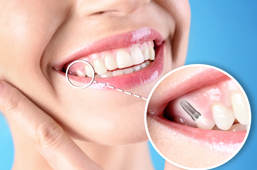 Close up of woman's smile with a dental implant